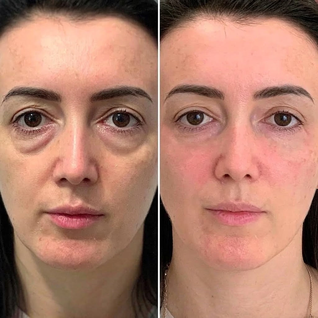 Relvani-Eyes® 2-in-1 Red Light Therapy + EMS To Erase Eye Bags